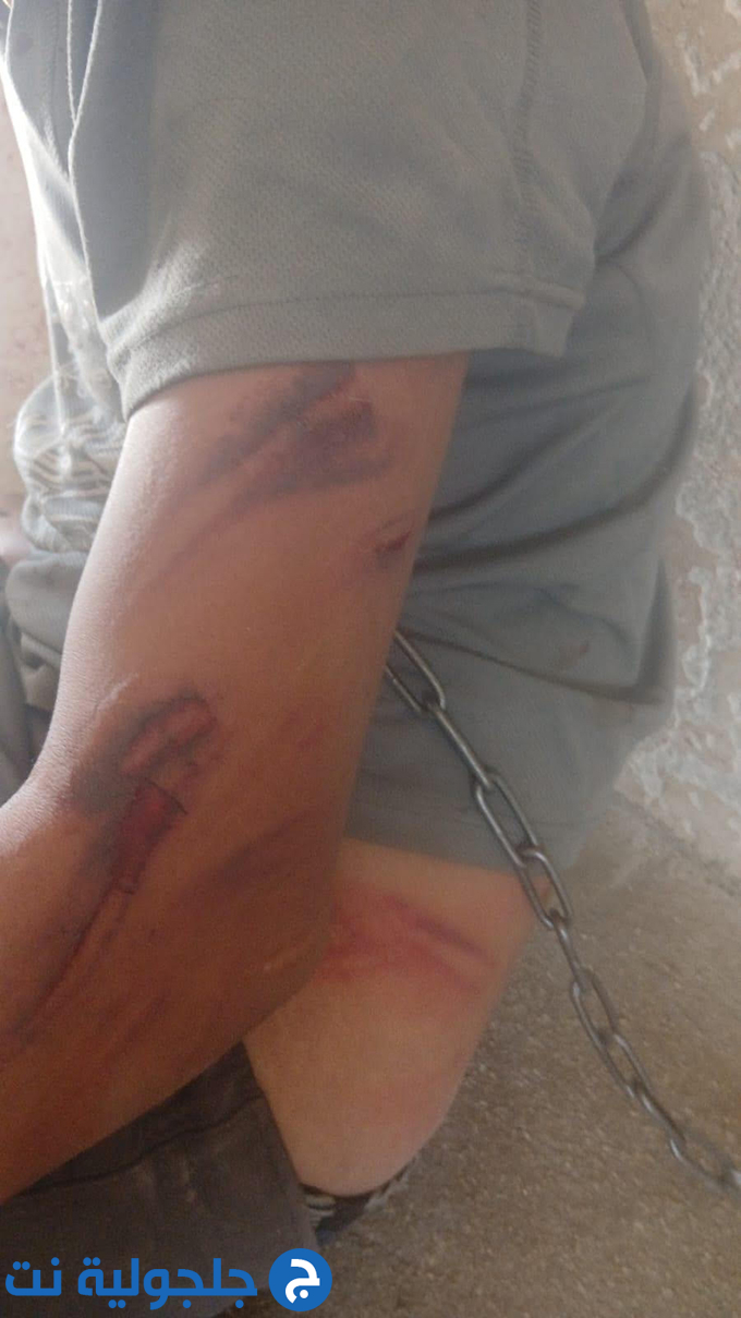 ضرب وتعذيب فتى من ذوي الاحتياجات الخاصة من قبل اقاربه في يطا